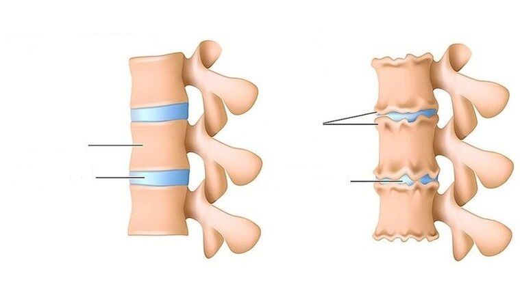 coloană vertebrală sănătoasă și coloană afectată de osteocondroză