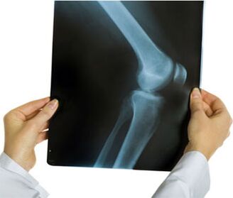 Radiografia artrozei genunchiului