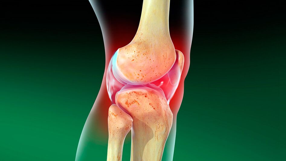 Artroza articulației genunchiului