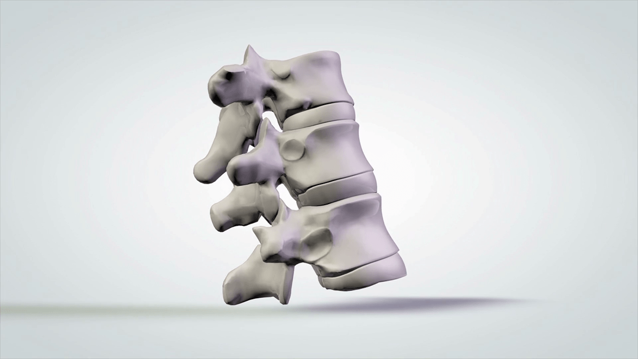 leziunea coloanei vertebrale în osteocondroza cervicală